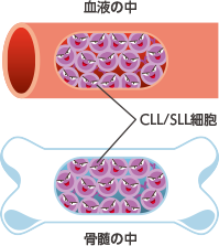 慢性リンパ性白血病(CLL)