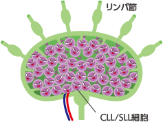 小リンパ球性リンパ腫(SLL)